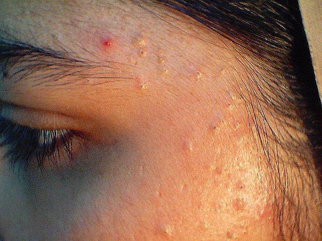 Excellent way to get normal skin appearance through acne treatment