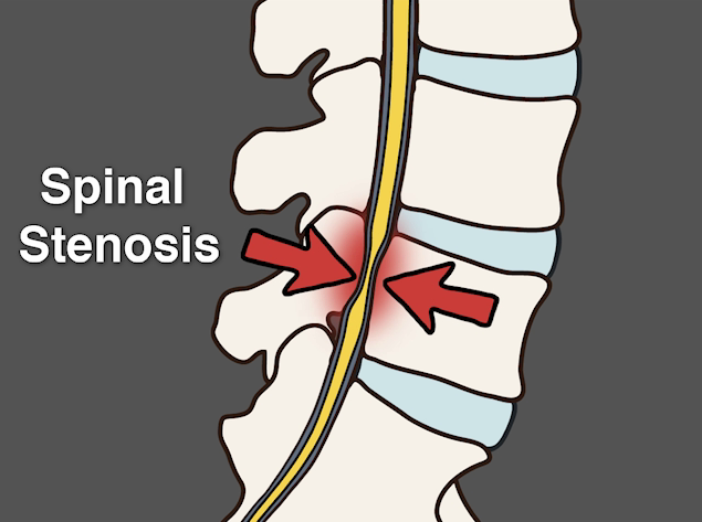 Some Information on Spinal Stenosis