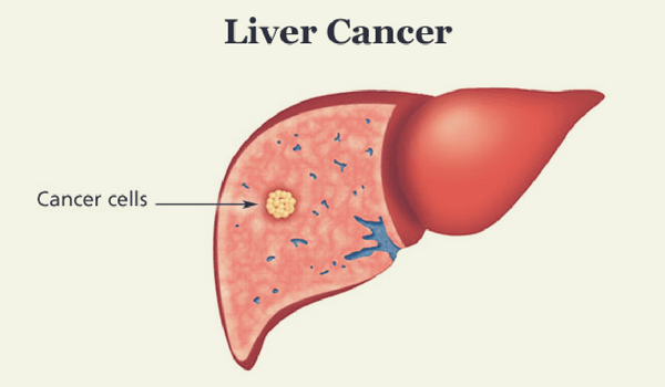 What a liver cancer surgery points to?