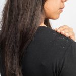 How to Cure Dandruff Permanently With Home Remedies? Ketomac Has the Answer