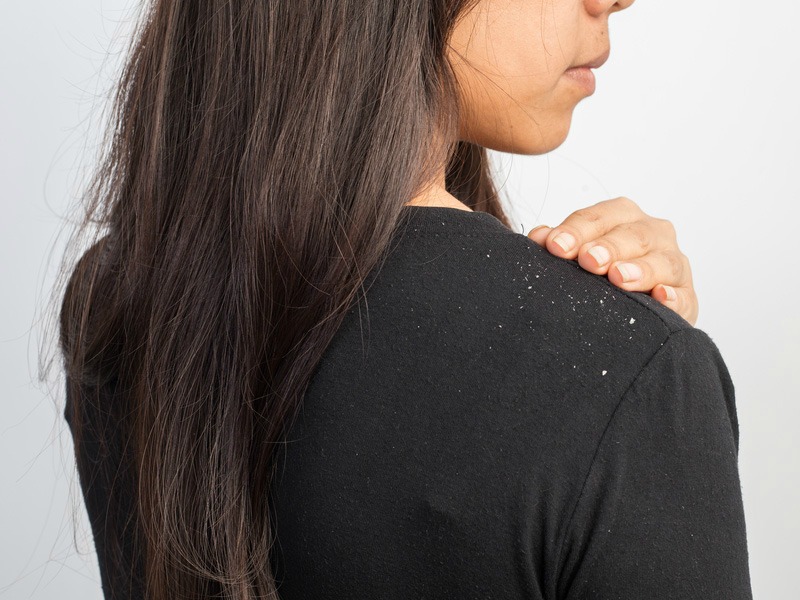 How to Cure Dandruff Permanently With Home Remedies? Ketomac Has the Answer