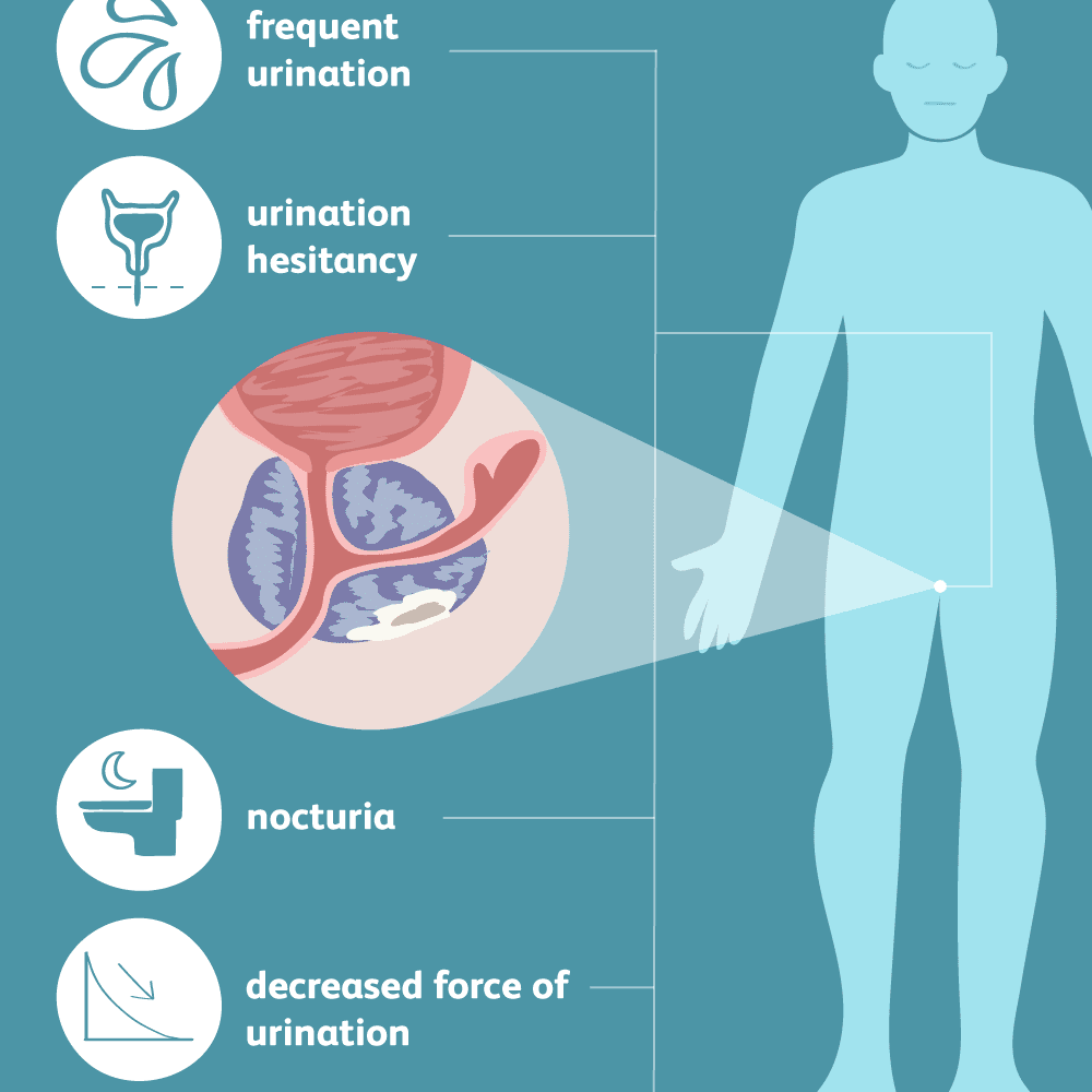 Prostate cancer surgery: About the early stage